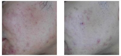 Sensitive skin soothed,