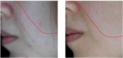 Redness reduced