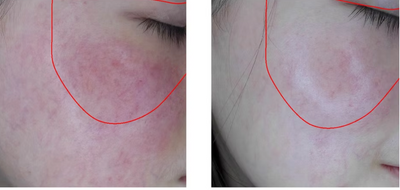 Inflammation reduced
