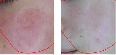 Redness reduced