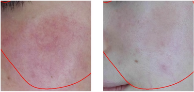 Inflammation reduced