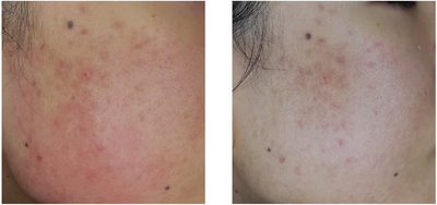 Acne marks faded