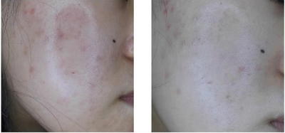 Acne improved