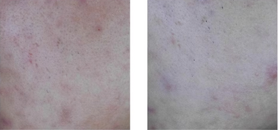 Acne inflammation reduced